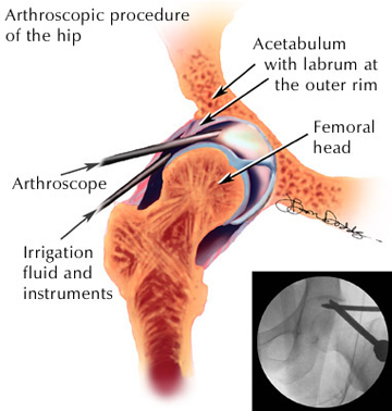 The location of the incisions and instruments for the procedure