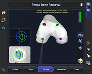 Navio Surgical System 3